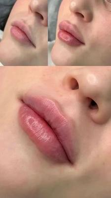 تزریق ژل و بوتاکس ،مزوژل در شاهین‌شهر