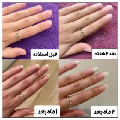 پک سرم تقویت ناخن افزایش رویش و رفع شکنندگی در کرج