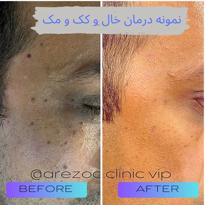 درمان لک / کک و مک / زیگیل/ خال / ریمو تاتو در اصفهان