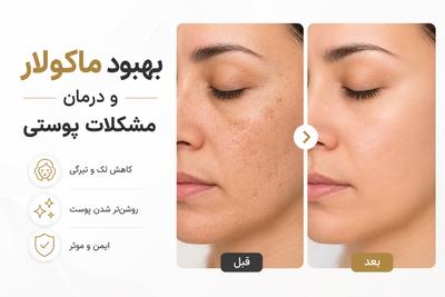 بهبود ماکولار و درمان مشکلات پوستی خود ایمن در اصفهان