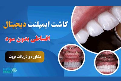 کاشت ایمپلنت دیجیتال اقساطی بدون سود در شیراز در انواع برندها در شیراز
