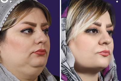 50 درصدتخفیف ساکشن غبغب با دکتر ساعدی در تهران