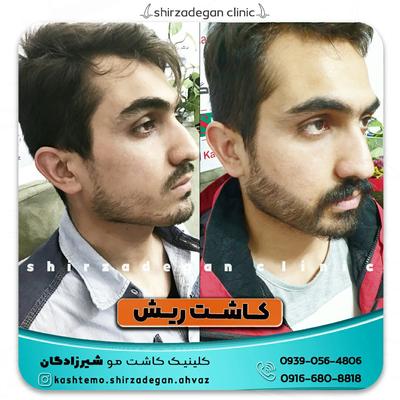 کاشت ریش شیرزادگان در اهواز