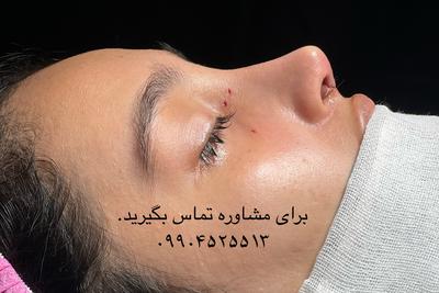 عمل زیبایی بینی سبکV(نچرال)بدون تامپون (۳۵ت) در تهران