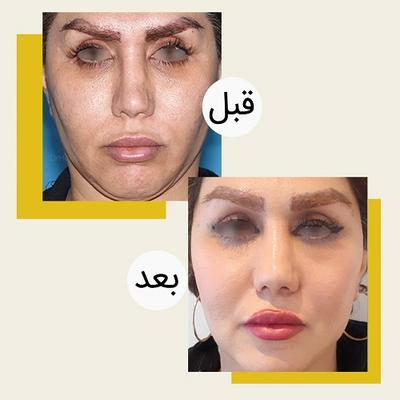لیفت گونه اندوسکپ در تهران