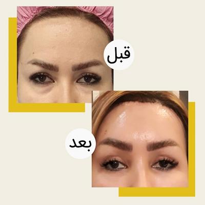 لیفت پیشانی اندوسکوپیک در تهران