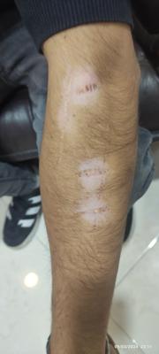 ترمیم جای زخم ها در قم