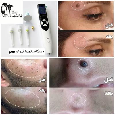 خال برداری با دستگاه پلاسما فیوژن paa در مشهد