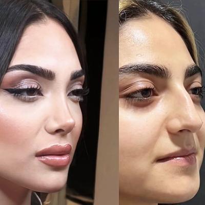 تغییر بینی نیمه گوشتی بعد از یک ماه از عمل در تهران