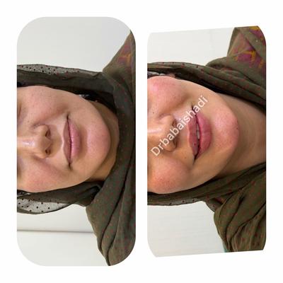 پکیج طلایی و نقره ای فول فیس در بندر عباس