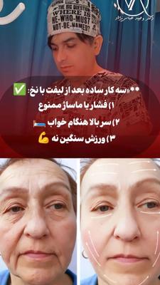 لیفت با نخ در تهران