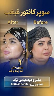 غبغب در تهران