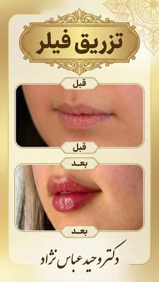 فیلر لب در تهران