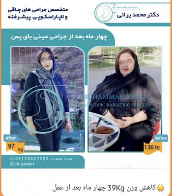 لاغری اسلیو معده با دکتر یرانی جراح با تجربه در تهران