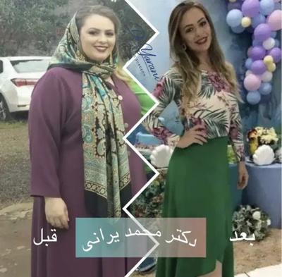 لاغری اسلیو معده با دکتر یرانی جراح با تجربه در تهران