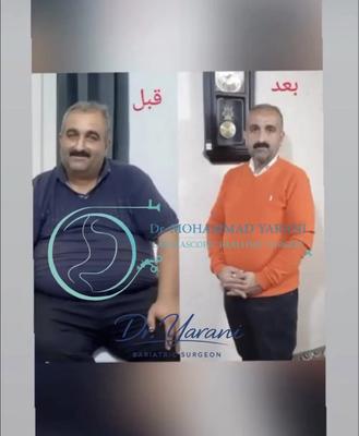 لاغری اسلیو معده با دکتر یرانی جراح با تجربه در تهران