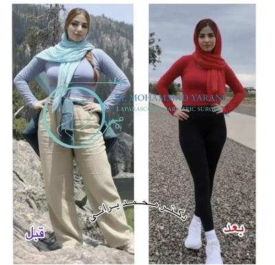 لاغری اسلیو معده با دکتر یرانی جراح با تجربه در تهران