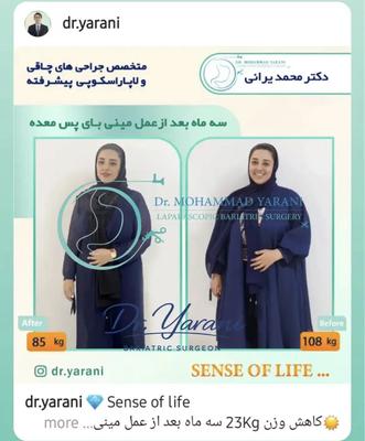 لاغری اسلیو معده با دکتر یرانی جراح با تجربه در تهران
