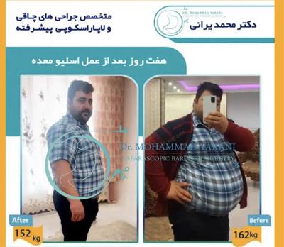 لاغری اسلیو معده با دکتر یرانی جراح با تجربه در تهران