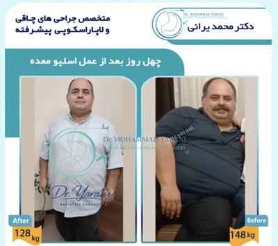 لاغری اسلیو معده با دکتر یرانی جراح با تجربه در تهران