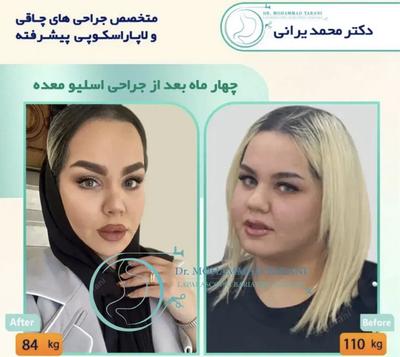 لاغری اسلیو معده با دکتر یرانی جراح با تجربه در تهران