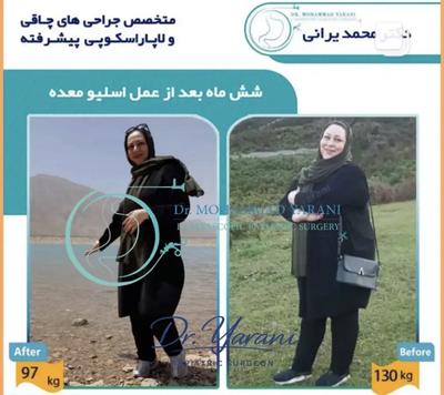 لاغری اسلیو معده با دکتر یرانی جراح با تجربه در تهران