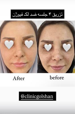 تزریق مزو مزوژل کوکتل و prp در اصفهان