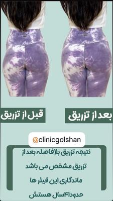 تزریق فیلر بادی هیپ دیپ دست باسن و پا در اصفهان