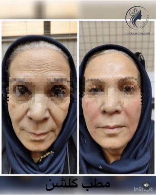 تزریق یک سی سی خط خنده در اصفهان