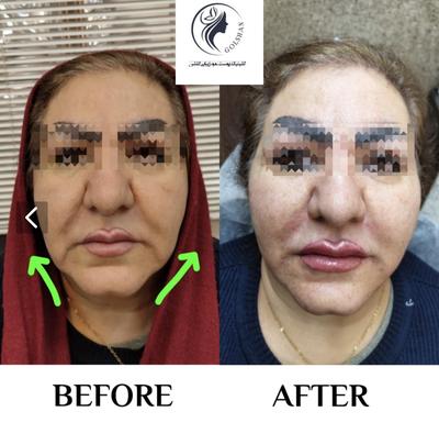 تزریق دو سی سی خط خنده در اصفهان