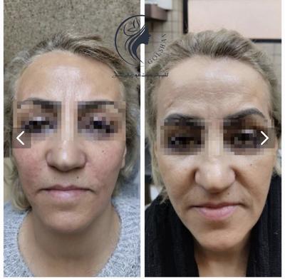 تزریق دو سی سی خط خنده در اصفهان