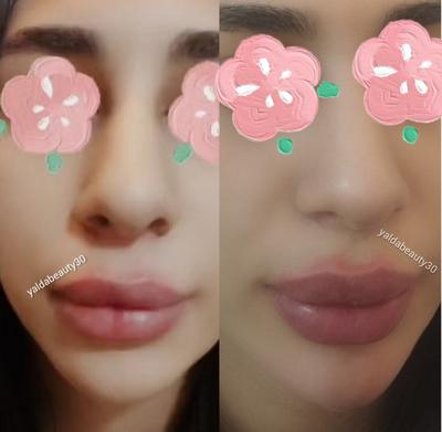 فیلر لب و چانه در شیراز