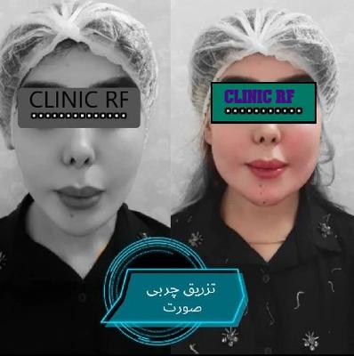 تزریق چربی در مشهد