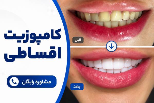 تا ۴۰٪ تخفیف🦷کامپوزیت🦷۱۰ سال ضمانت کتبی+جرم گیری رایگان🎯09305925252 در تهران
