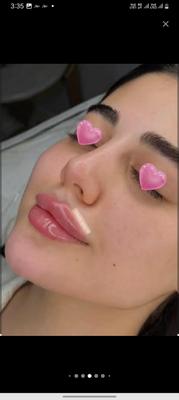 فیلر لب در مشهد