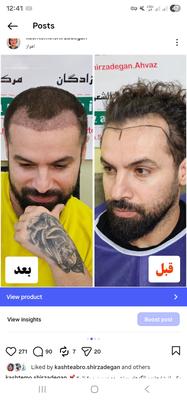 کاشت در ناحیه خط رویش در اهواز