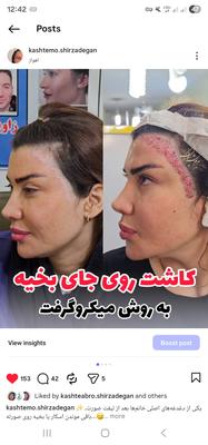 کاشت روی بخیه ، سوختگی و تصادف در اهواز