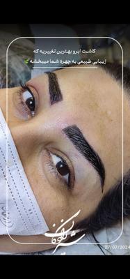 کاشت ابرو شیرزادگان در اهواز