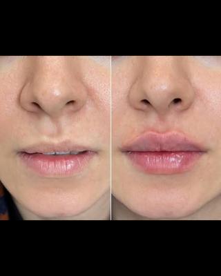 تزریق ژل لب متد روسی در اصفهان