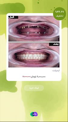 ایمپلنت در تهران