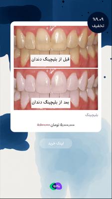 بلیچینگ در تهران
