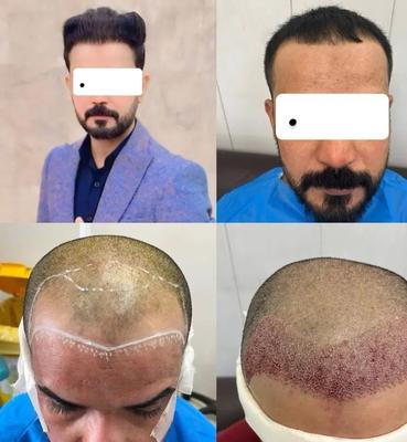کاشت مو هیرسا با تیم پزشکی VIP در تهران