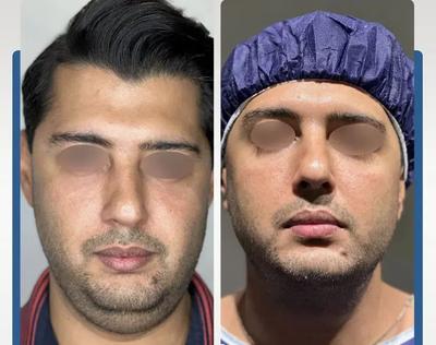 ساکشن غبغب و بوکال فت صورت در مشهد