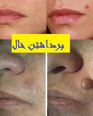 برداشتن خال با لیزر در یک جلسه در مشهد