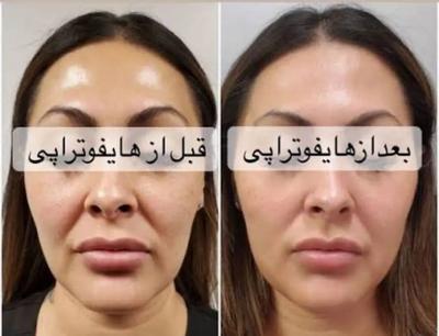 انجام خدمات فشیال،هایفو،برداشت خال در کلینیک تخصصی در تهران