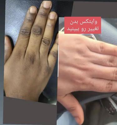 وایتکس بدن صورت ضدلک سفید روشن تضمین بدون بازگشت در تهران