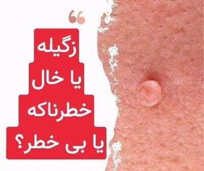 رفع تخصصی زگیل و زائده‌های پوستی بدون برگشت در مشهد