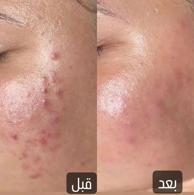 درمان جوش های صورت در تهران