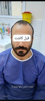 کاشت مو و ابروی طبیعی در اصفهان در اصفهان