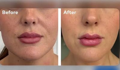 تخفیفات تزریق جالپرو پروفایلو و مزوژل جوانساز در قم